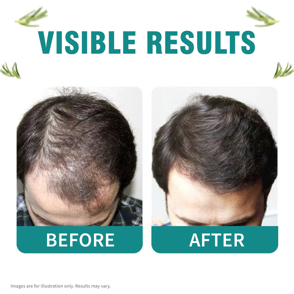 Hair Growth Kit